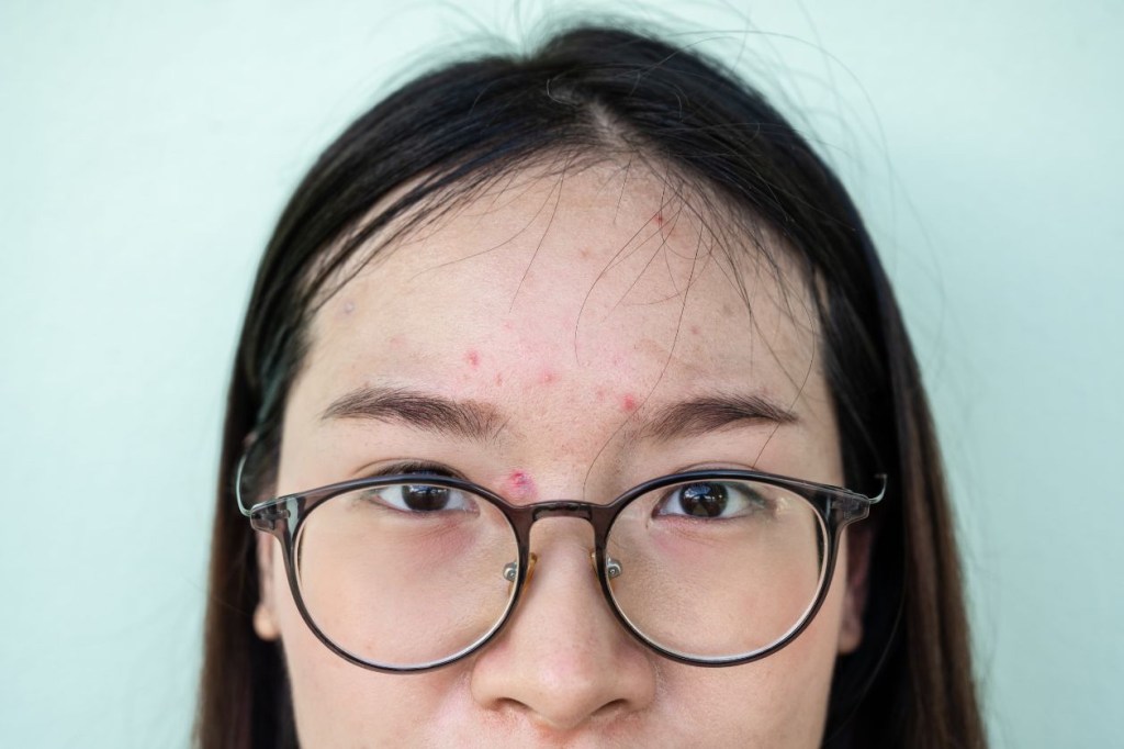 Bacterial Acne: What Is It and How Can You Treat&nbsp;It?